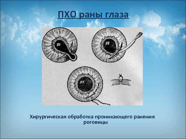 ПХО раны глаза Хирургическая обработка проникающего ранения роговицы 