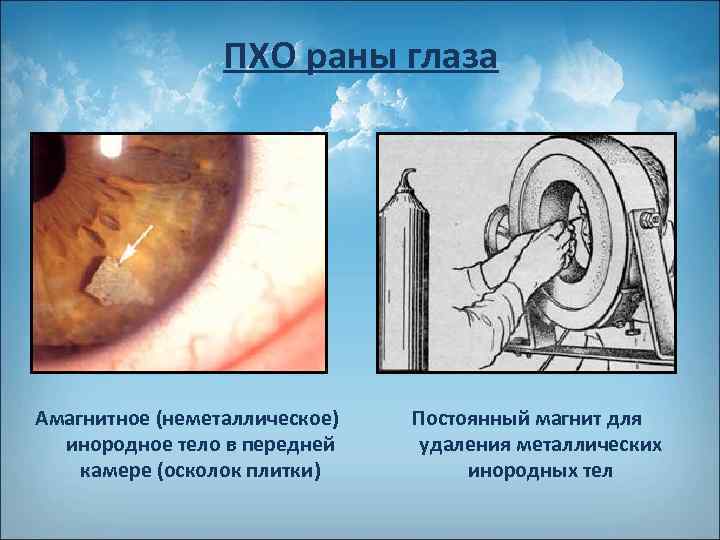 ПХО раны глаза Амагнитное (неметаллическое) инородное тело в передней камере (осколок плитки) Постоянный магнит