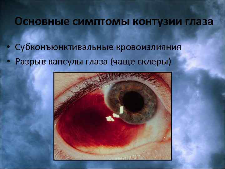 Основные симптомы контузии глаза • Субконъюнктивальные кровоизлияния • Разрыв капсулы глаза (чаще склеры) 