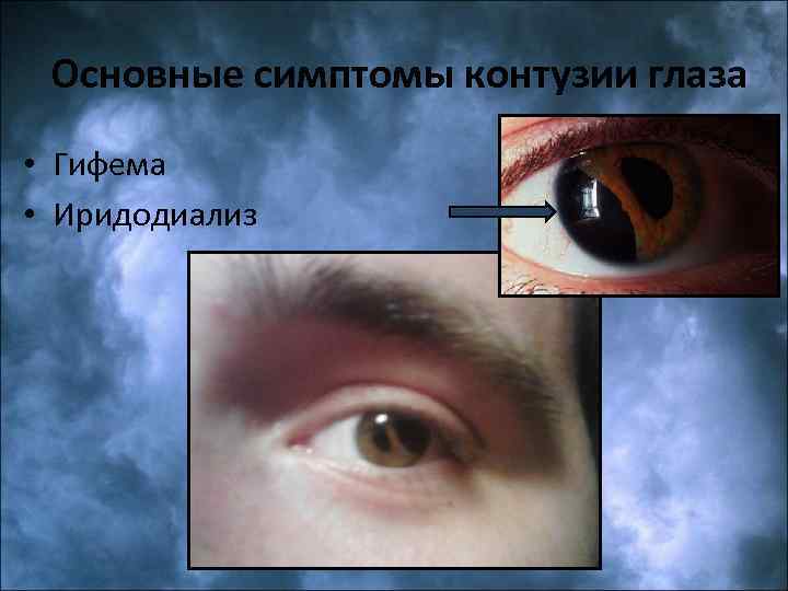 Основные симптомы контузии глаза • Гифема • Иридодиализ 