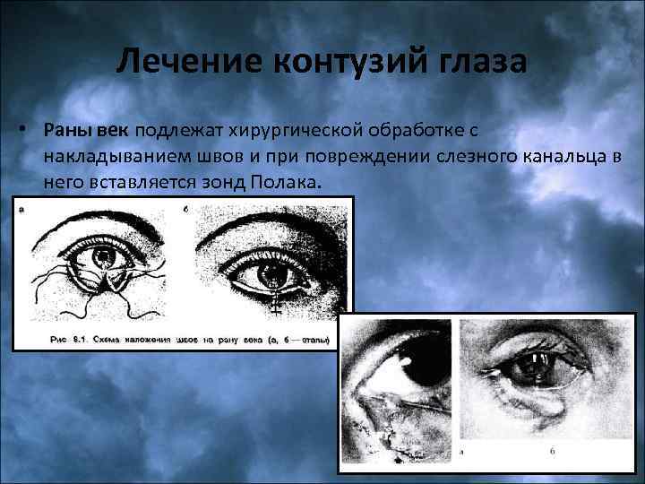 Лечение контузий глаза • Раны век подлежат хирургической обработке с накладыванием швов и при