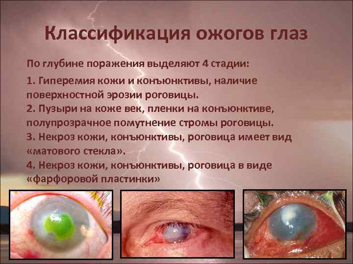 Классификация ожогов глаз По глубине поражения выделяют 4 стадии: 1. Гиперемия кожи и конъюнктивы,