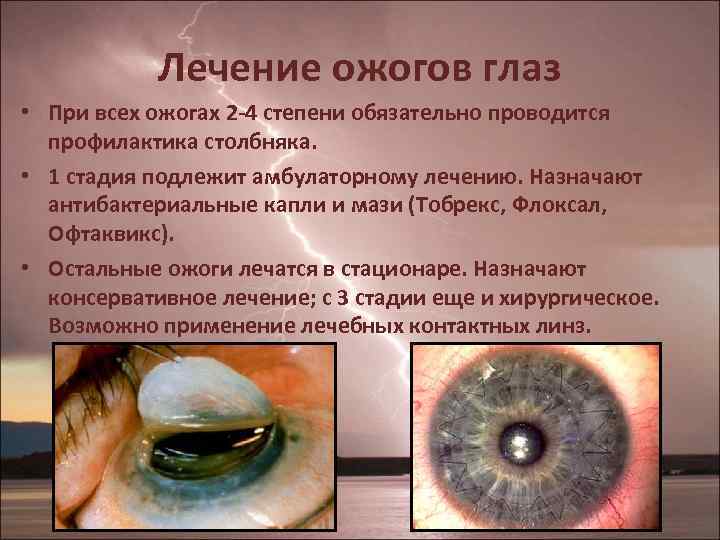 Лечение ожогов глаз • При всех ожогах 2 -4 степени обязательно проводится профилактика столбняка.