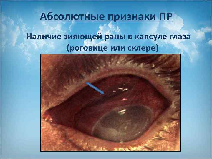 Абсолютные признаки ПР Наличие зияющей раны в капсуле глаза (роговице или склере) 