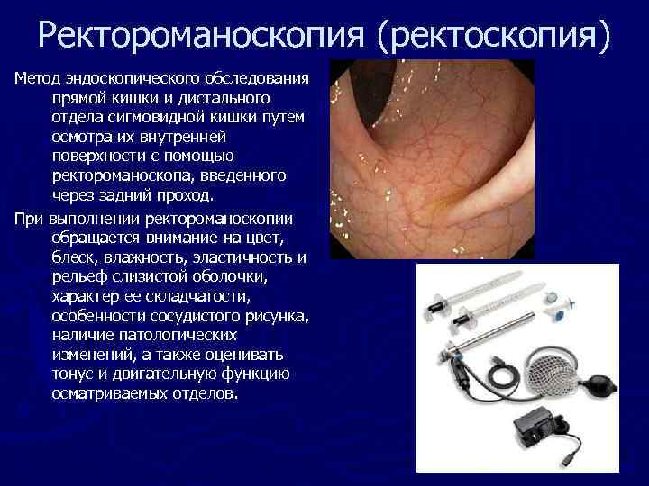  Ректороманоскопия (ректоскопия) Метод эндоскопического обследования прямой кишки и дистального отдела сигмовидной кишки путем