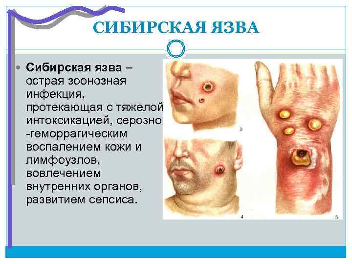 Сибирская язва фото у человека