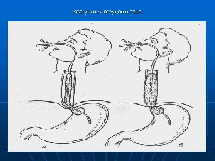 Коагуляция сосудов в ране 