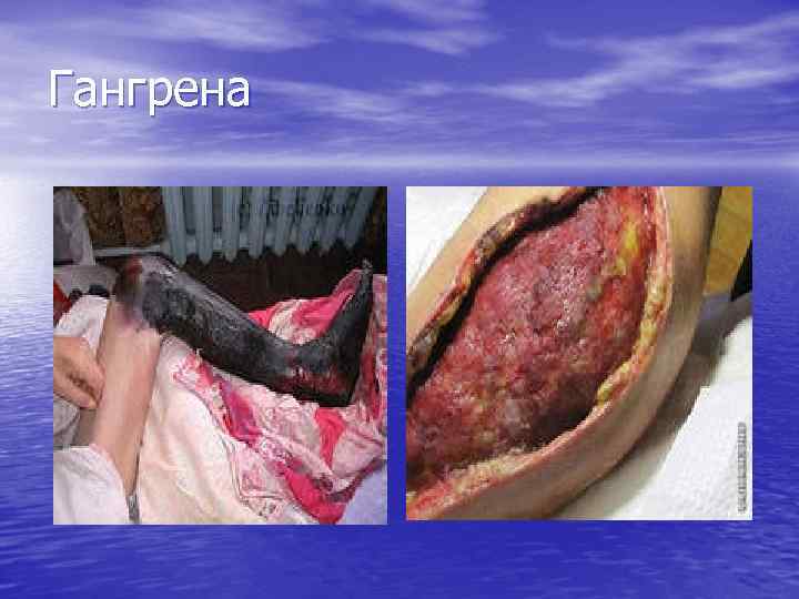 Гангрена 