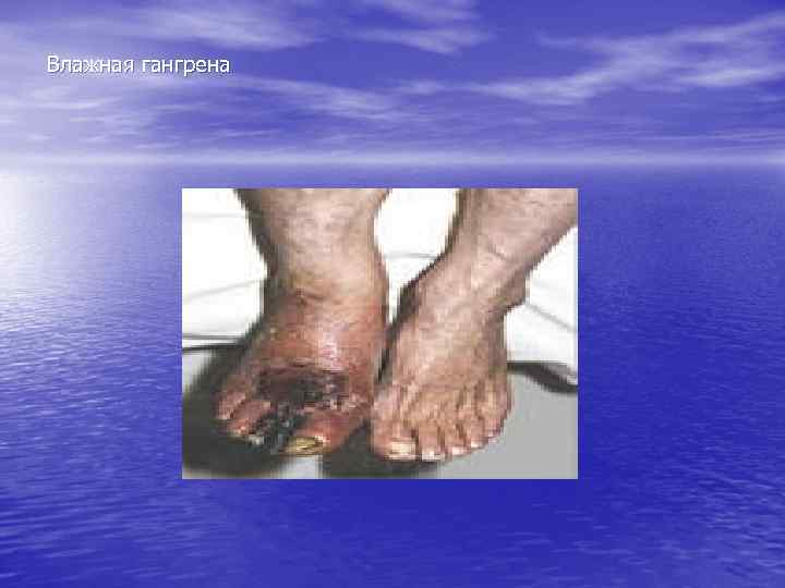 Влажная гангрена 