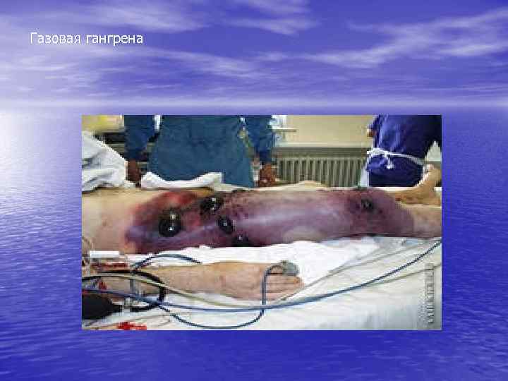 Газовая гангрена 