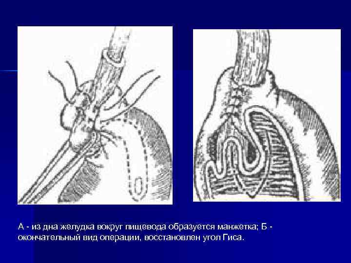 А - из дна желудка вокруг пищевода образуется манжетка; Б - окончательный вид операции, А - из дна желудка вокруг пищевода образуется манжетка; Б - окончательный вид операции,