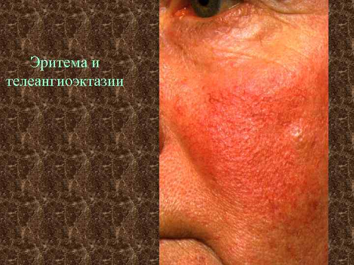   Эритема и телеангиоэктазии 