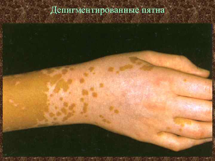 Депигментированные пятна 
