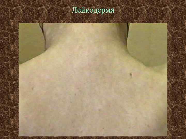 Лейкодерма 