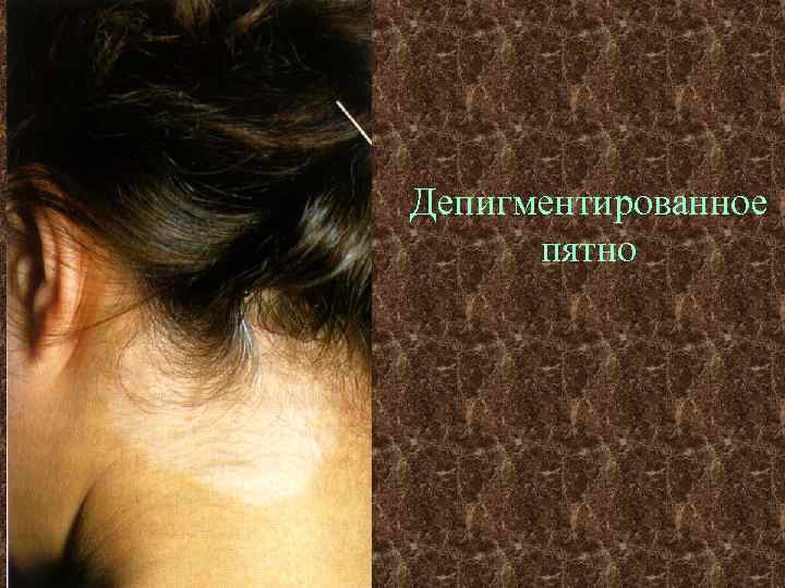 Депигментированное  пятно 