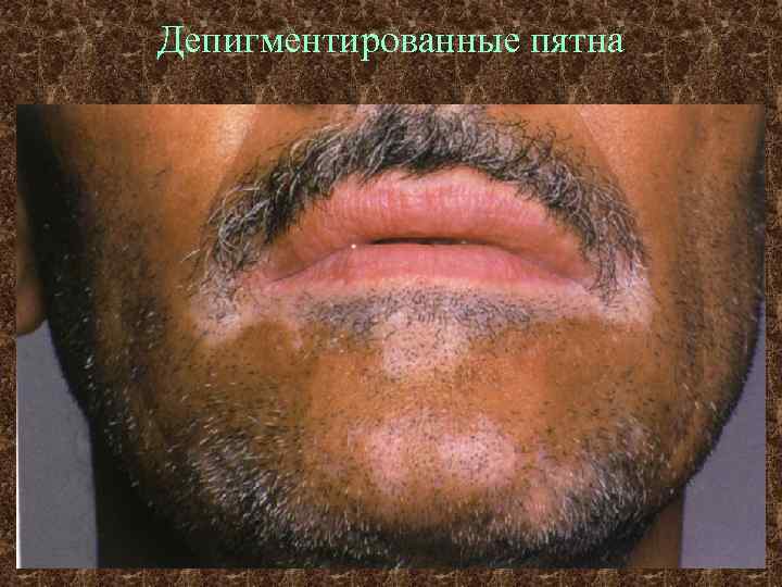 Депигментированные пятна 