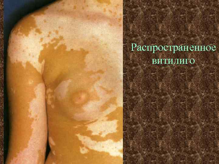 Распространенное витилиго 