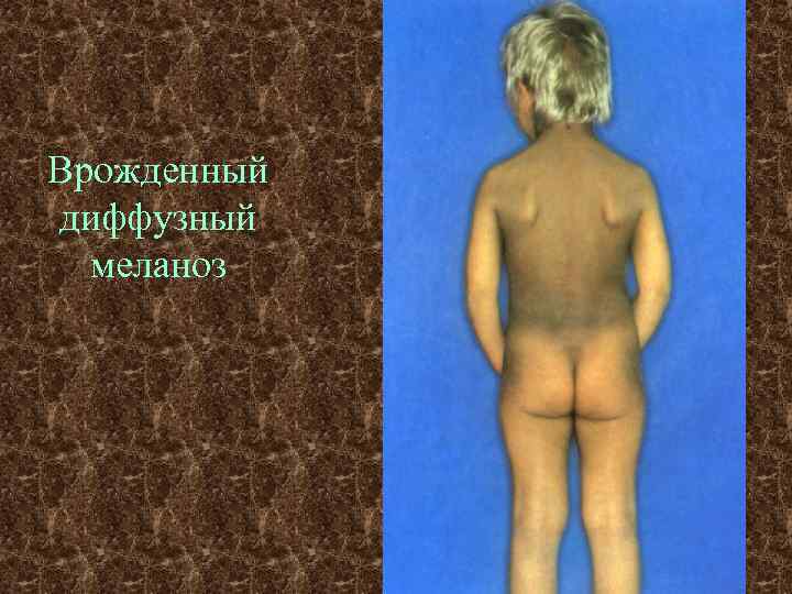 Врожденный диффузный  меланоз 