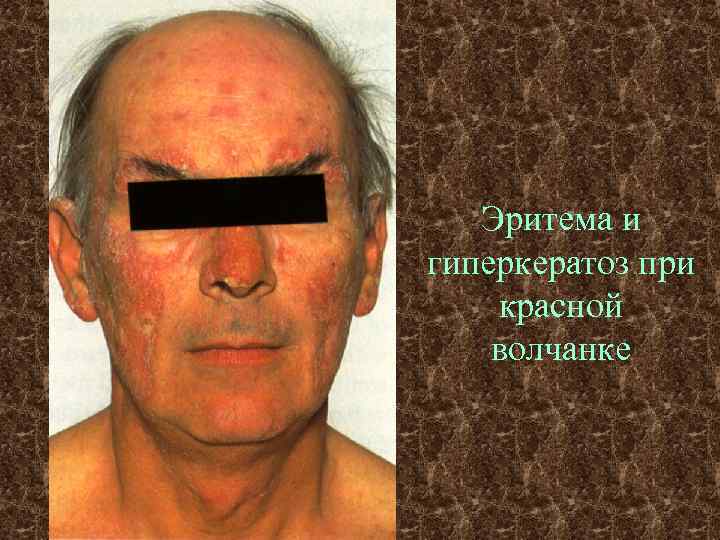   Эритема и гиперкератоз при красной волчанке 