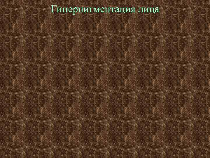 Гиперпигментация лица 