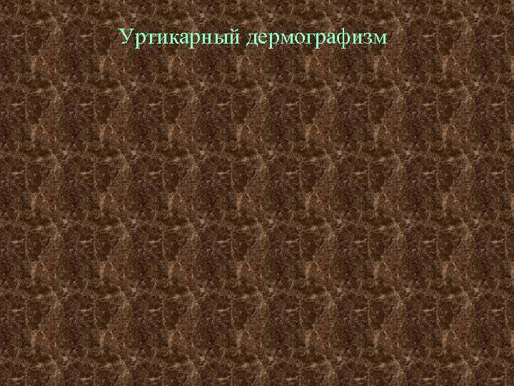 Уртикарный дермографизм 