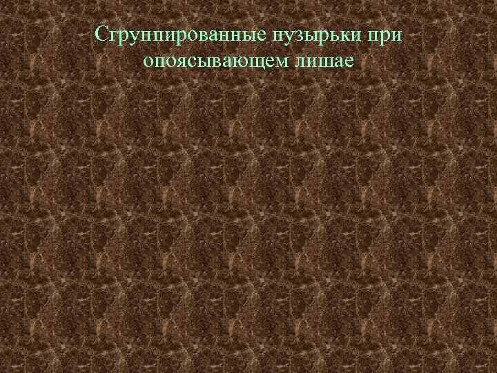 Сгруппированные пузырьки при опоясывающем лишае 