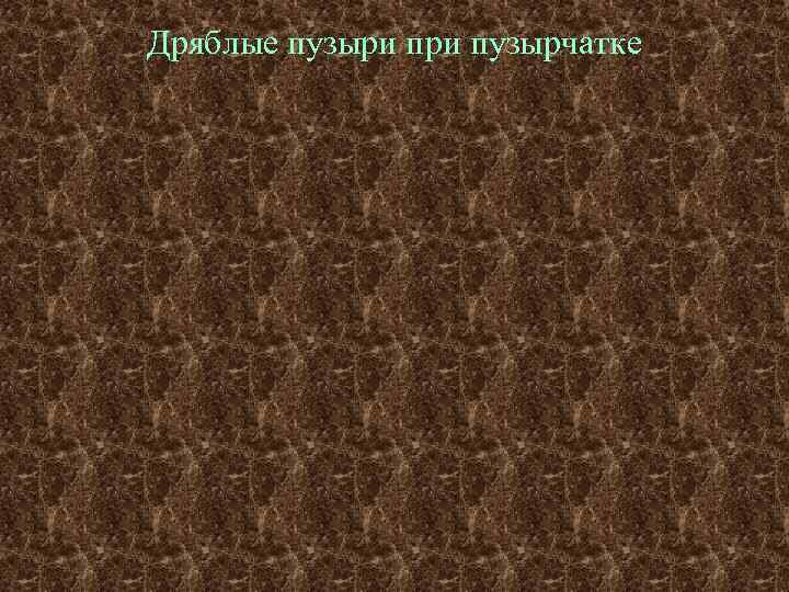 Дряблые пузыри пузырчатке 