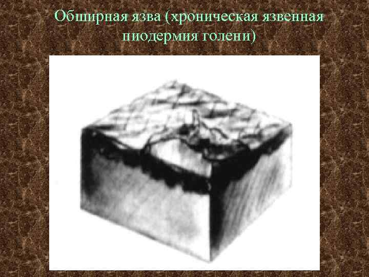 Обширная язва (хроническая язвенная  пиодермия голени) 