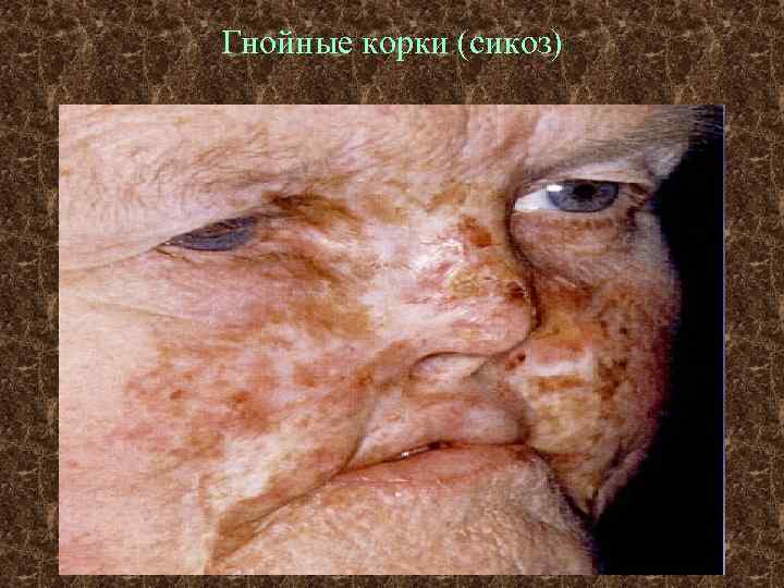 Гнойные корки (сикоз) 