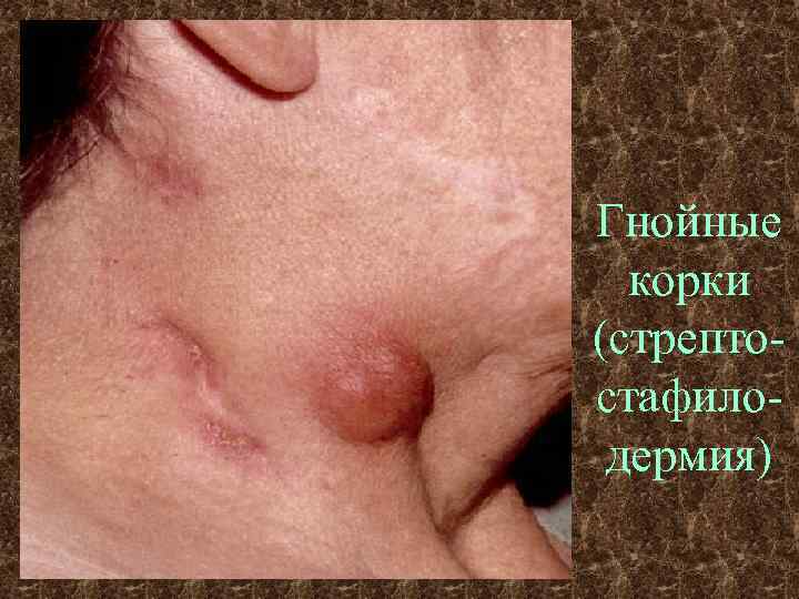 Гнойные  корки (стрепто- стафило- дермия) 