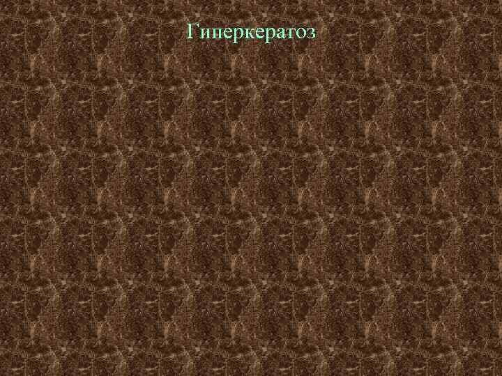 Гиперкератоз 