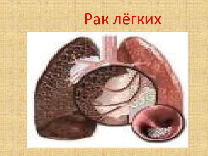 Рак лёгких Рак лёгких