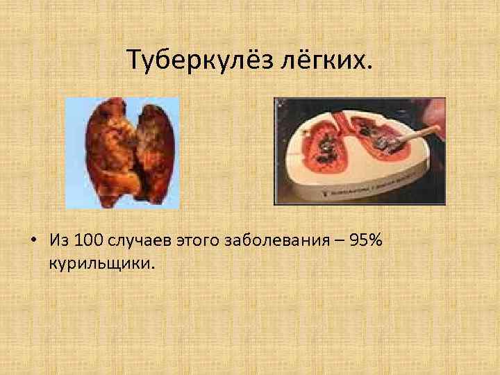 Туберкулёз лёгких. • Из 100 случаев этого заболевания – 95% Туберкулёз лёгких. • Из 100 случаев этого заболевания – 95%