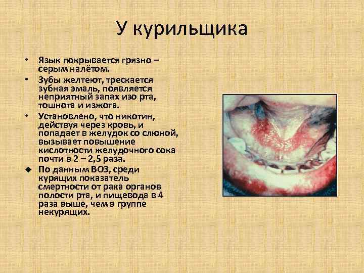 У курильщика • Язык покрывается грязно – серым налётом. У курильщика • Язык покрывается грязно – серым налётом.