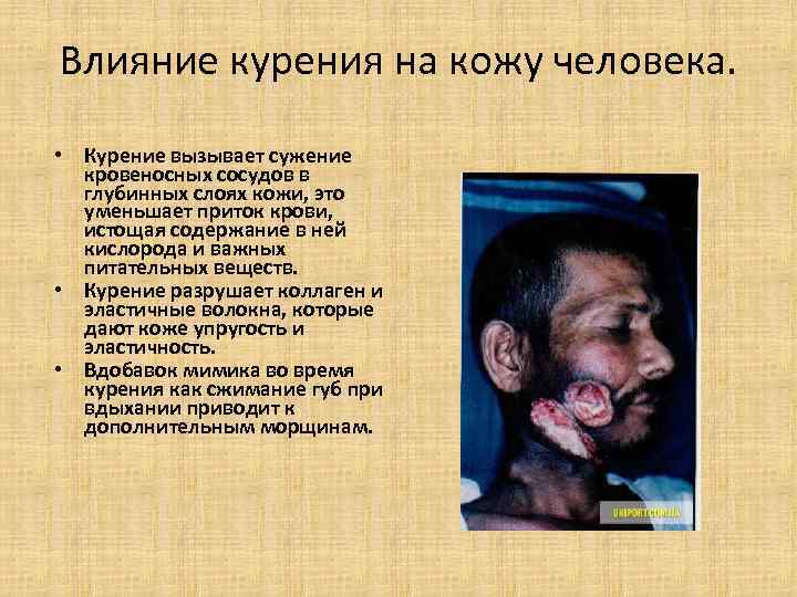 Влияние курения на кожу человека. • Курение вызывает сужение кровеносных сосудов в Влияние курения на кожу человека. • Курение вызывает сужение кровеносных сосудов в