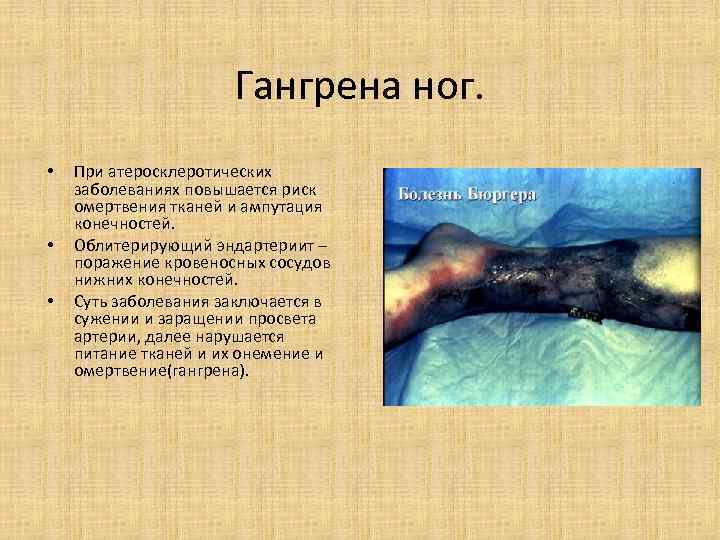 Гангрена ног. • При атеросклеротических заболеваниях повышается Гангрена ног. • При атеросклеротических заболеваниях повышается