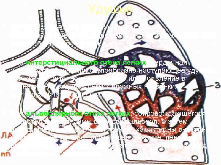      Удушье • Связано с внезапно наступающей острой  левожелудочковой