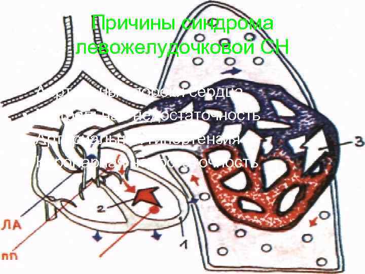    Причины синдрома   левожелудочковой СН  •  Аортальные пороки