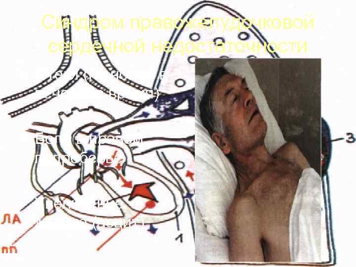  Синдром правожелудочковой  сердечной недостаточности • Отеки (на ногах, в  вечернее время)