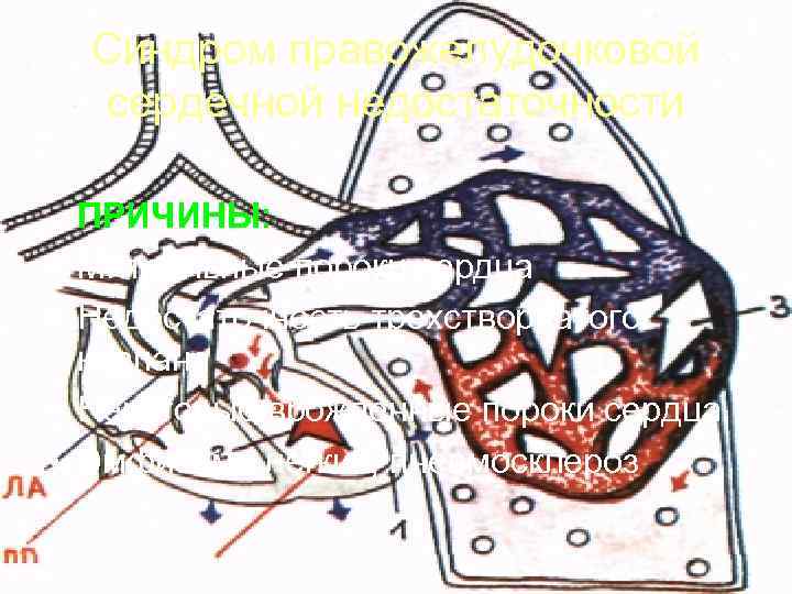   Синдром правожелудочковой сердечной недостаточности ПРИЧИНЫ:  •  Митральные пороки сердца •