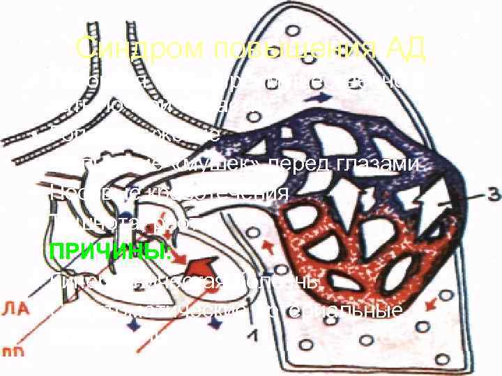   Синдром повышения АД • Головная боль (преимущественно в  затылочной области) •