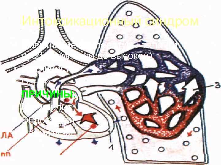  Интоксикационный синдром • Повышение температуры тела (от  субфебрильной до высокой) • Потливость