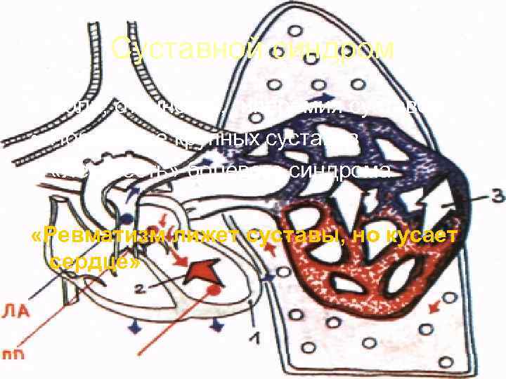   Суставной синдром • Боли, отечность, гиперемия суставов • Поражение крупных суставов •