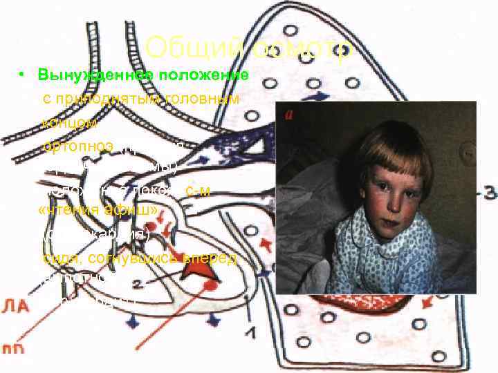    Общий осмотр • Вынужденное положение:  - с приподнятым головным концом