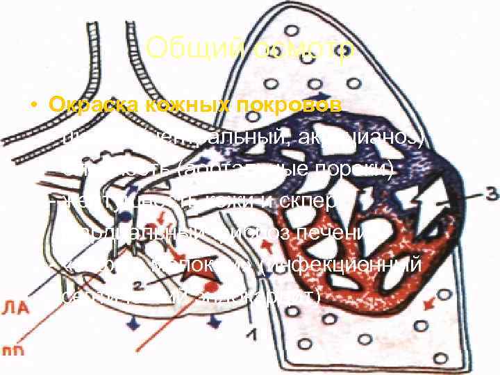   Общий осмотр • Окраска кожных покровов  - цианоз (центральный, акроцианоз)