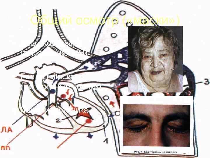   Общий осмотр ( «маски» ) • Лицо Корвизара  (выраженная СН) 