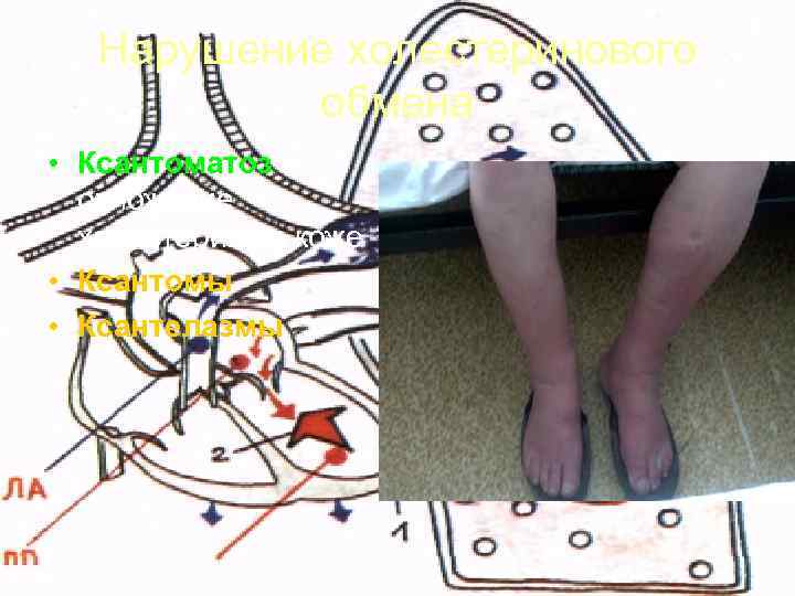   Нарушение холестеринового  обмена • Ксантоматоз –  отложение  холестерина в