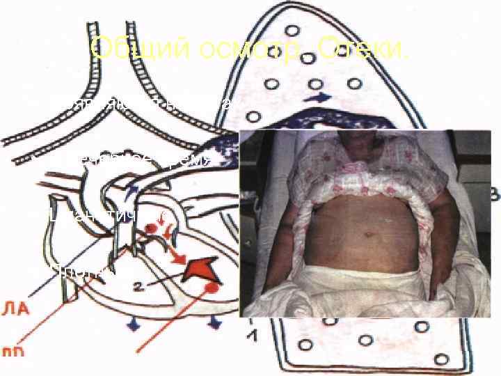  Общий осмотр. Отеки.  • Появляются на ногах  • В вечернее время
