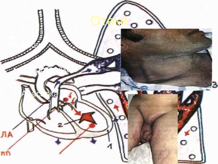     Отеки • Асцит  • Гидроторакс  • Анасарка 