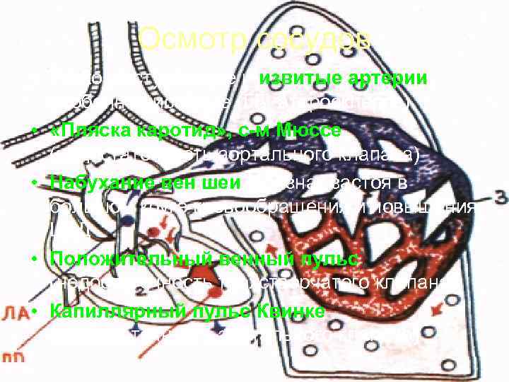    Осмотр сосудов • Резко выступающие и извитые артерии,  особенно височные